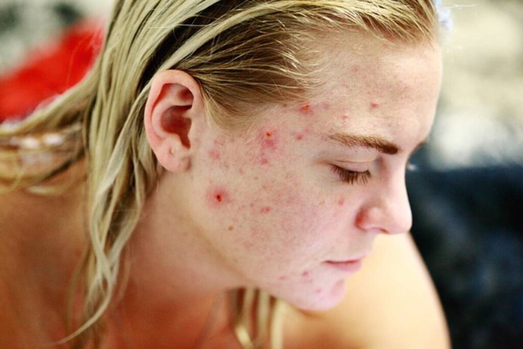Which Foods Cause Eczema